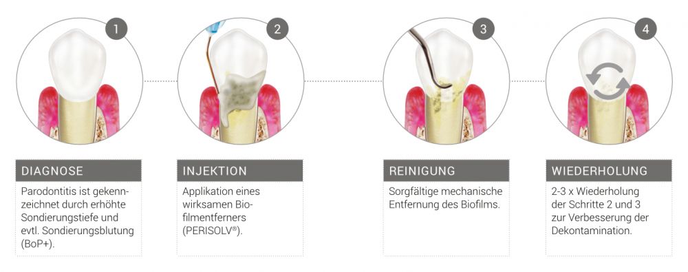 Nichtchirurgische PA-Therapie