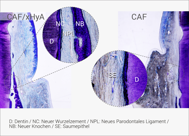 Rezessionsdeckung / Plastisch-Ästhetische Chirurgie