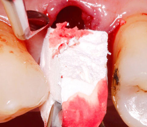 Bild Regedent OSSIX BONE Case Report 2