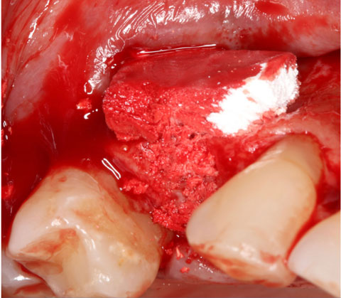 Bild Regedent OSSIX BONE Case Report 4