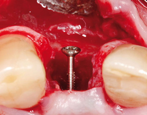 Bild Regedent OSSIX PLUS Case Report 3