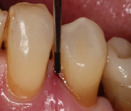 Bild Regedent PERISOLV Case Report 1