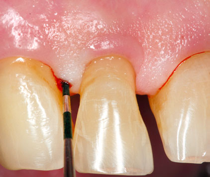 Bild Regedent PERISOLV Case Report 2