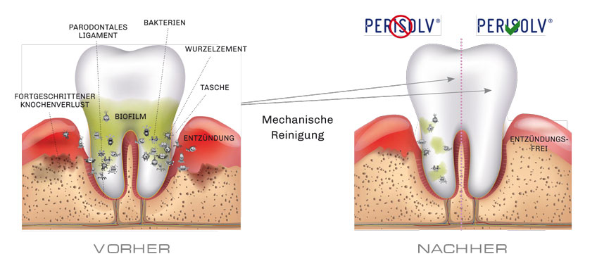 Bild Regedent PERISOLV Technologie