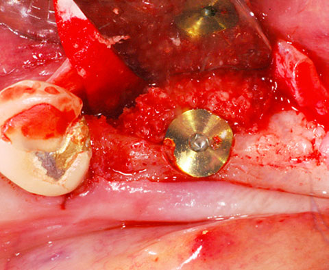 Bild OSSIX SMARTBRANE Case Report 1
