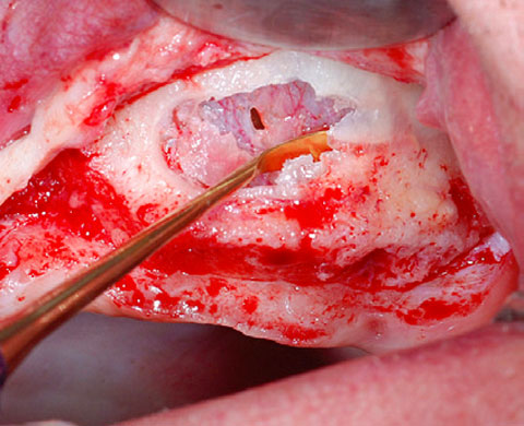 Bild OSSIX SMARTBRANE Case Report 1