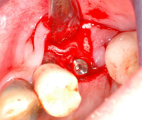 Bild Regedent OSSIX VOLUMAX Case Report 1