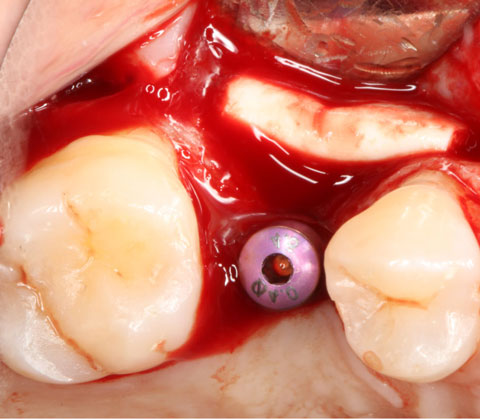 Bild Regedent OSSIX VOLUMAX Case Report 4